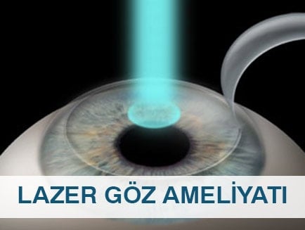 lazer göz ameliyatı