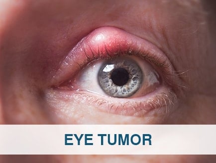 göz tümörü