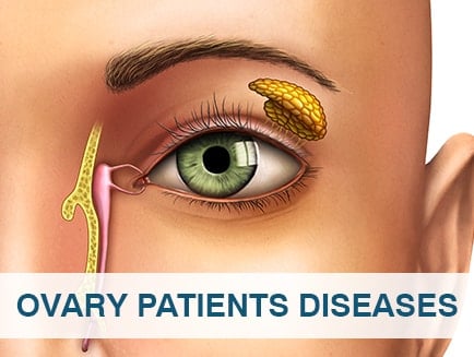 OVARY PATIENTS DISEASES
